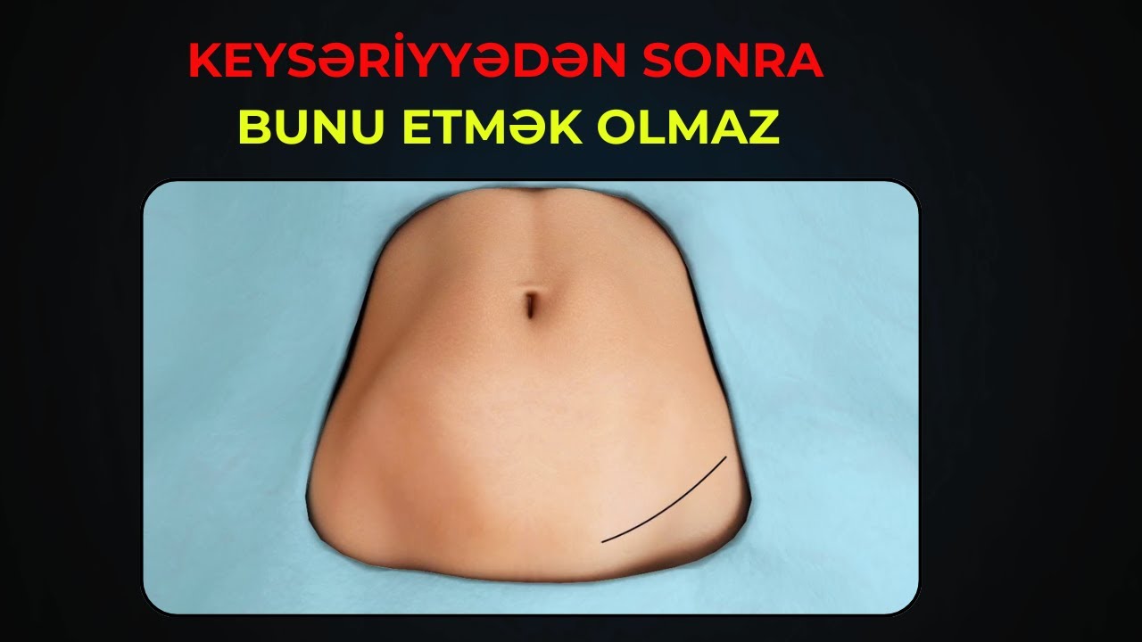 Keysəriyyə SONRASI Abdominoplastika - Olarmı?