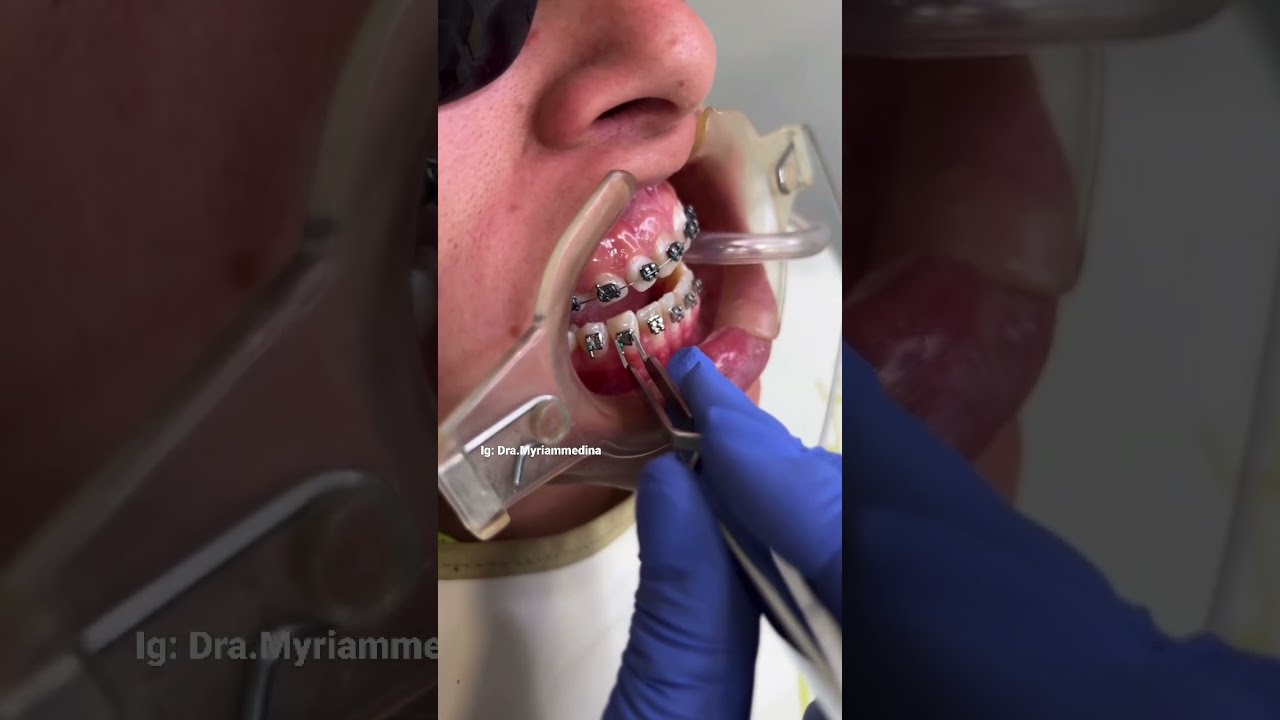Quieres ver cómo pongo brackets? #dentista #morelia