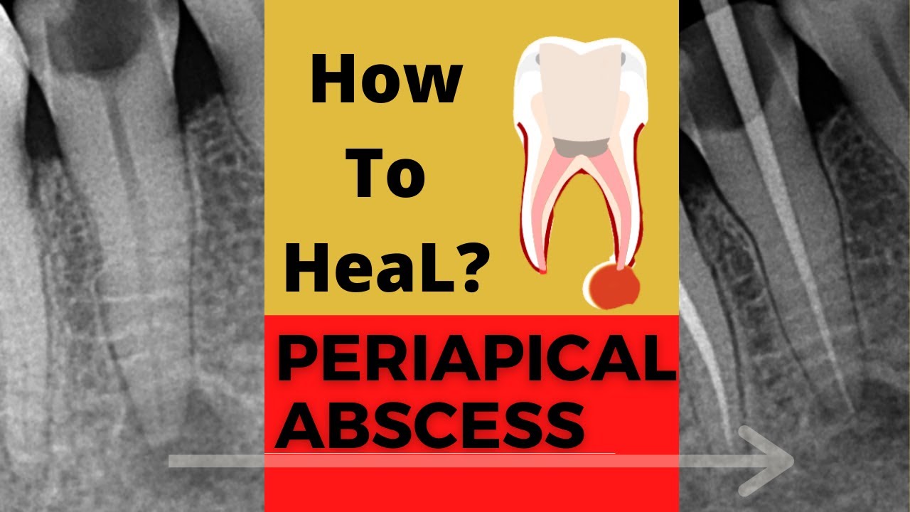 Case of PERIAPICAL ABSCESS| Dr. Sunil kumar| Dental ji