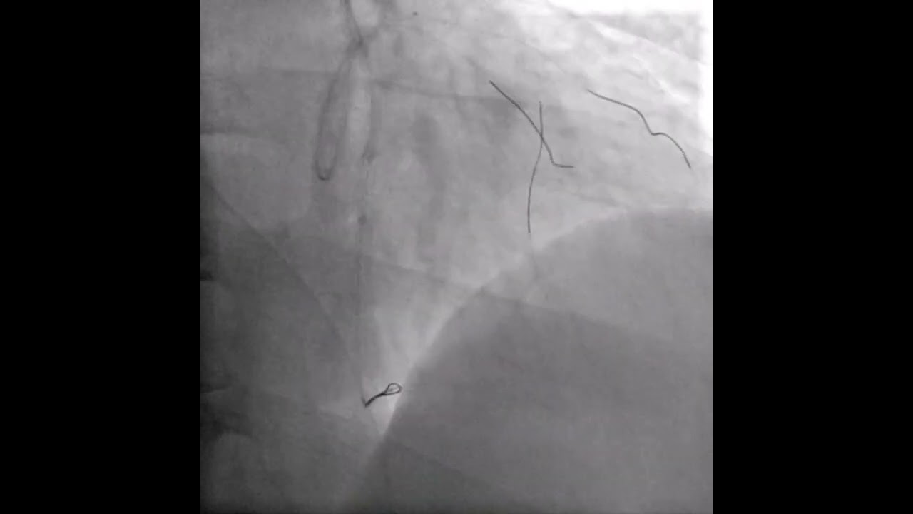 Prof.Dr. Ömer Göktekin, Dr. Haşim Tüner CTO PCI via another CTO.