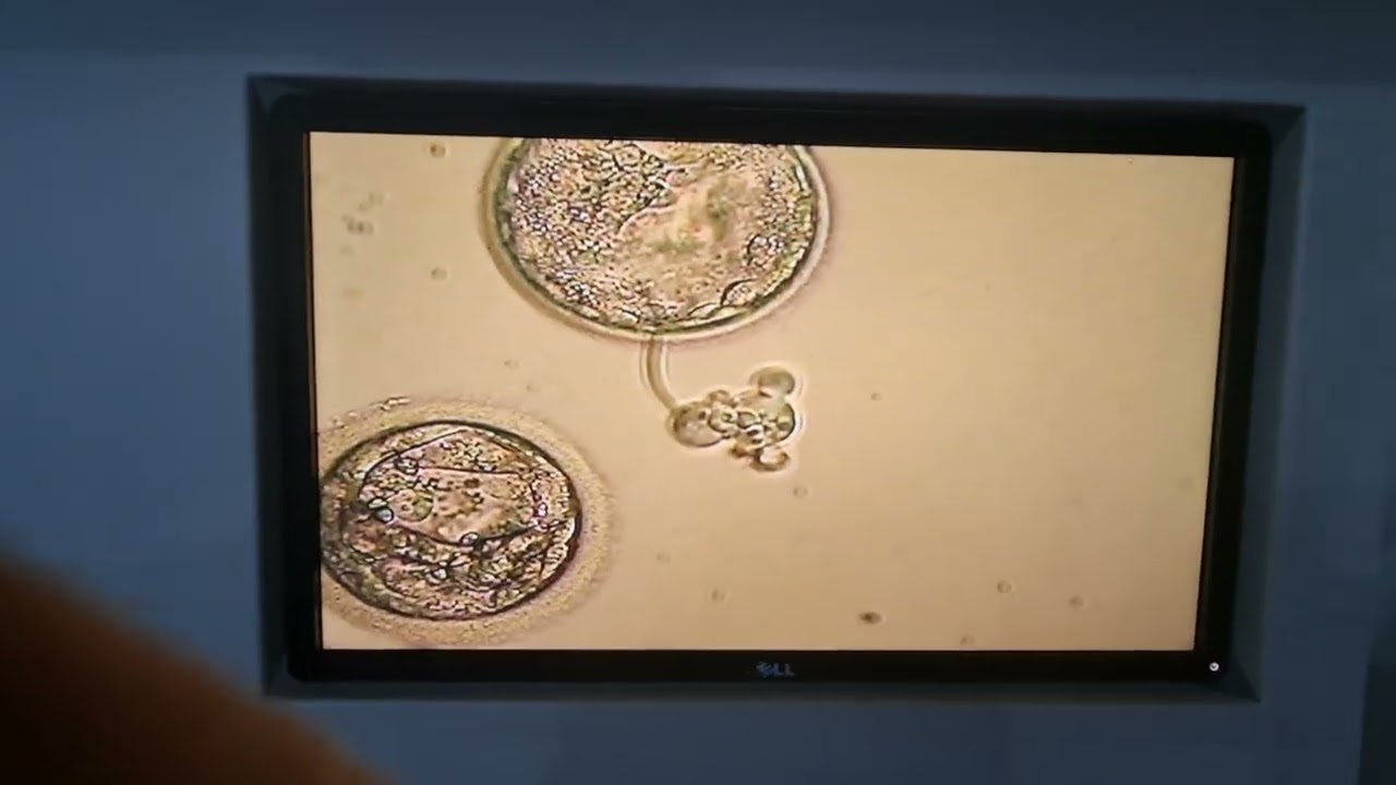Live : Day 5 embryo, to be frozen ( vitrification)