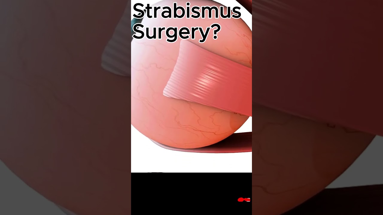 Strabismus Surgery in Action 👁️ Fixing Crossed Eyes | Hypertropia Explained ⚕️ 3D Medical Animation