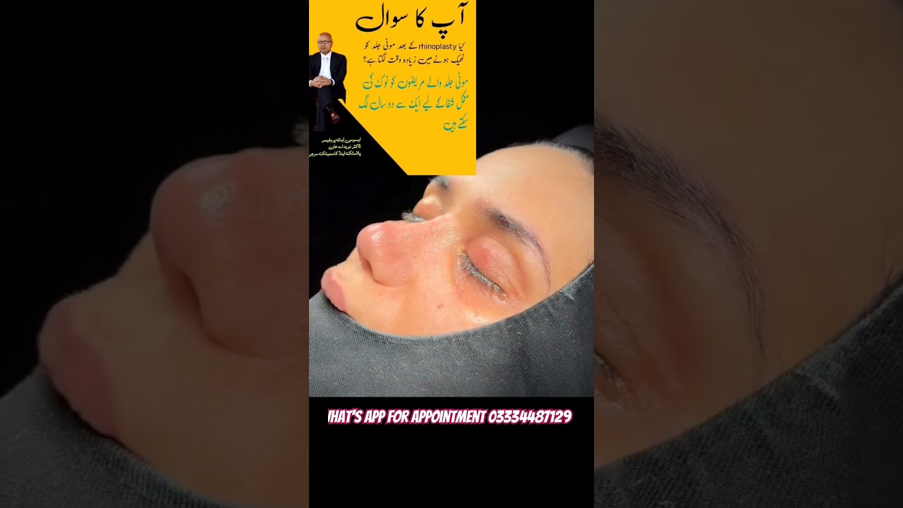 #MaleRhinoplasty#NoseSurgery#FacialSurgery#CosmeticSurgery#PlasticSurgery#MenBeauty