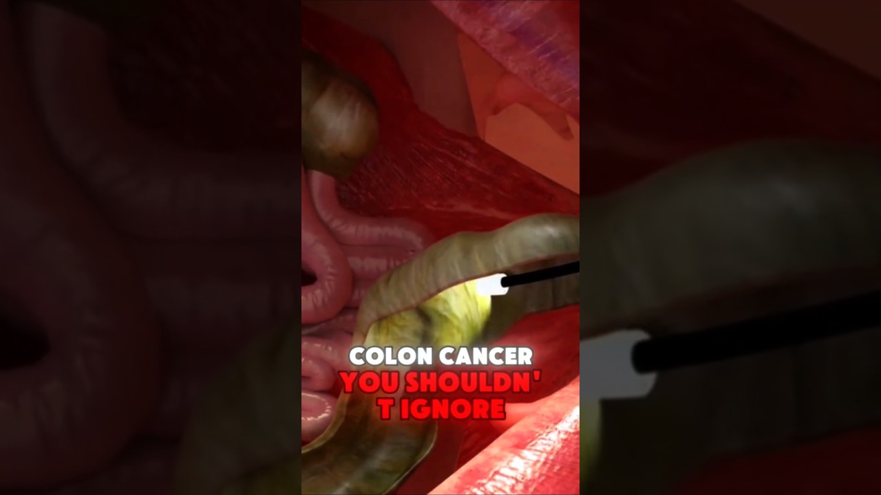 8 Warning Signs Of Colon Cancer
