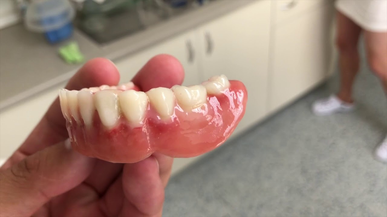 Teleskopická zubní náhrada PEEK - JS Lab