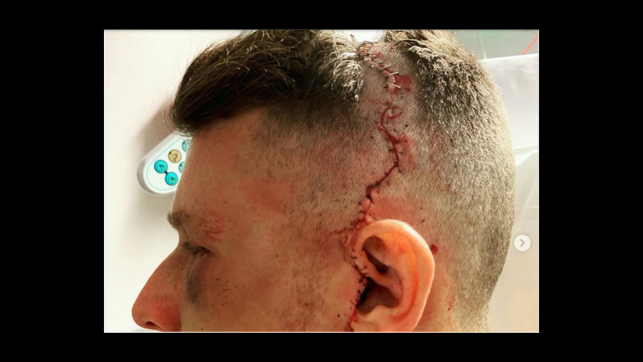 Sam Ward injury