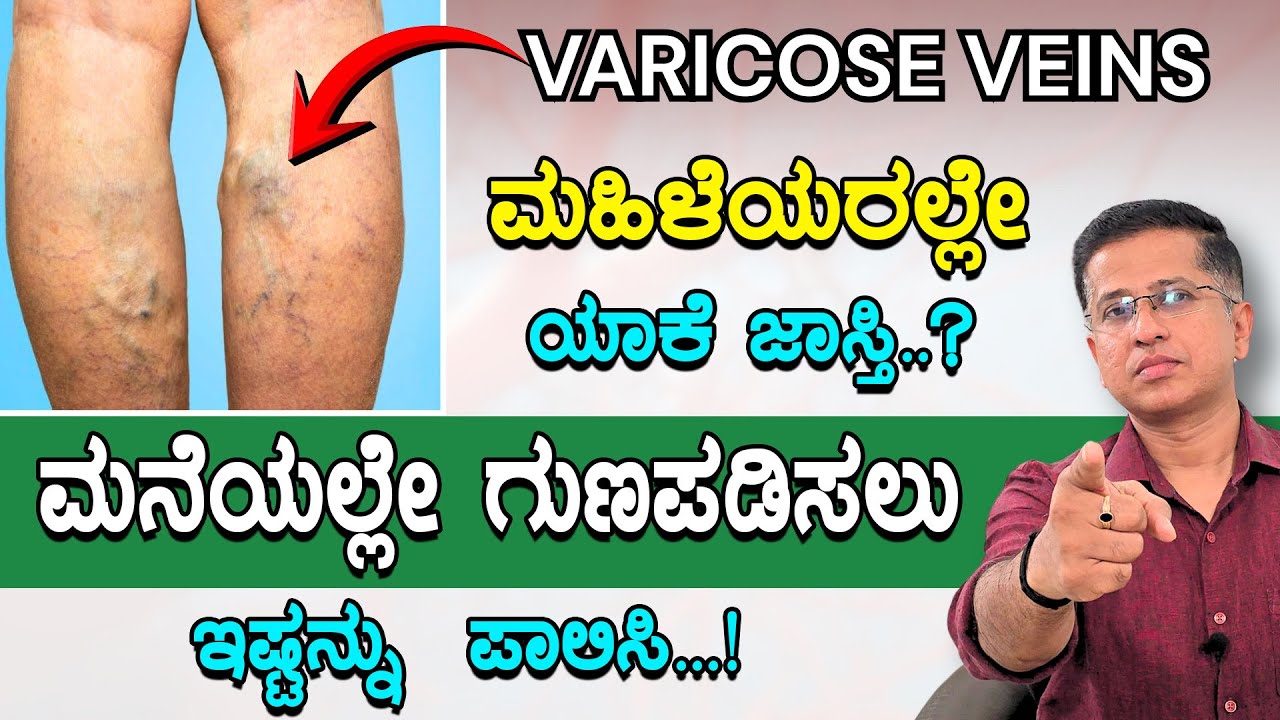 Varicose Veins Symptoms And Home Remedies In Kannada | ಇಷ್ಟನ್ನು  ಪಾಲಿಸಿ  ಮನೆಯಲ್ಲೇ ಗುಣಪಡಿಸಬಹುದು