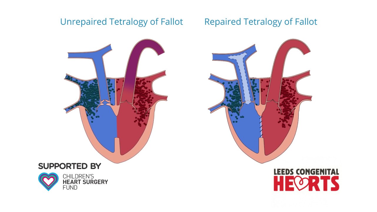 Tetralogy of Fallot: Initial repairs