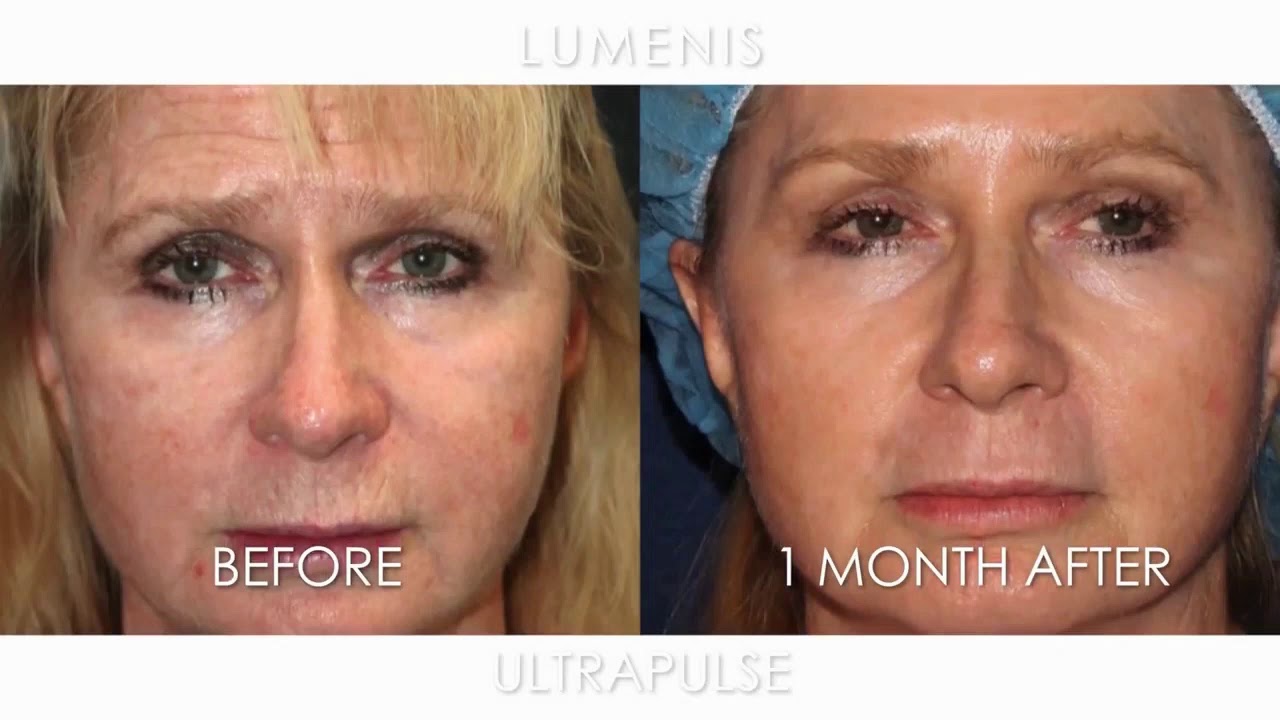 Dr. Daniel Friedmann is Using UltraPulse ActiveFX (Korean Subtitles)