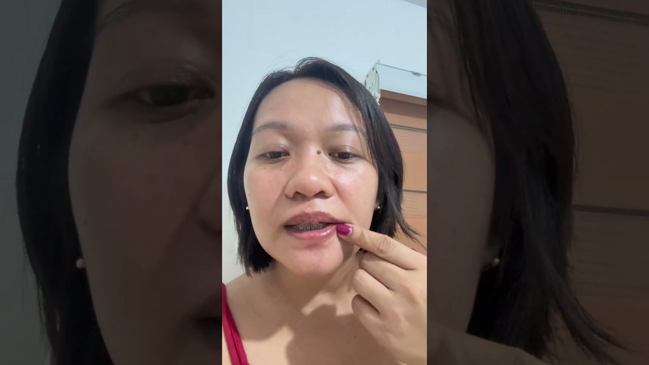 I Survived 30 Days of Braces… Here’s What REALLY Happened | My experience and results