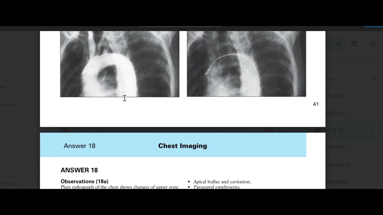 Subclavian steal syndrome as a refractory peripheral arterial disease