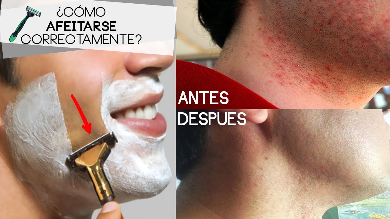 ¿CÓMO AFEITARSE? HOMBRES - Consejos para evitar alergias después de rasurar
