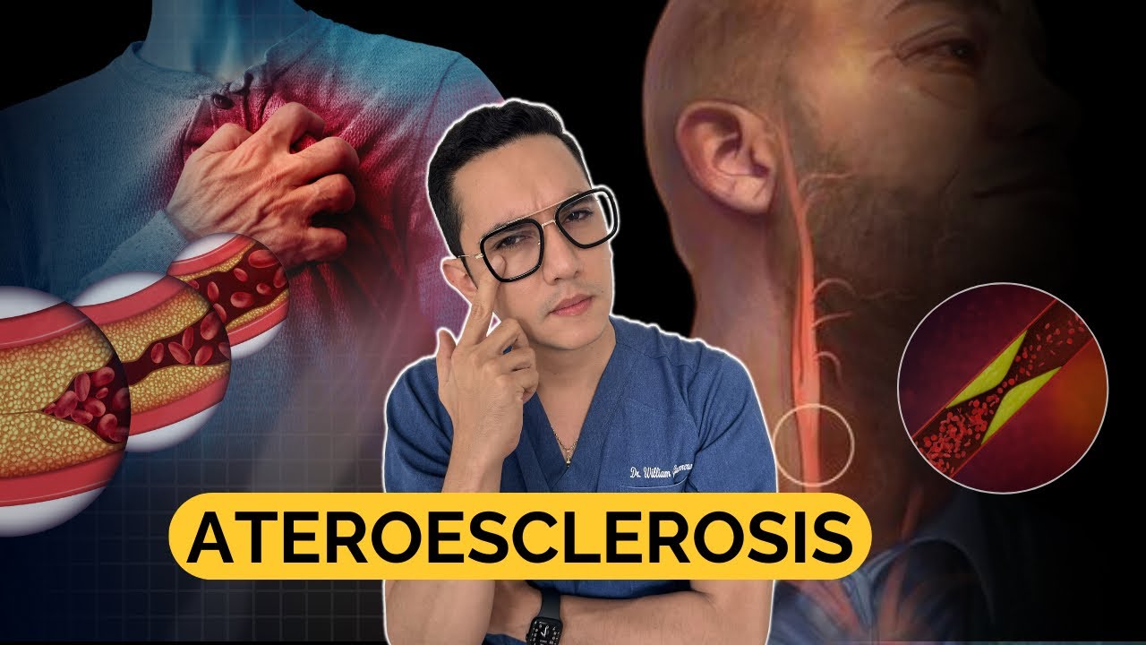 ATEROESCLEROSIS, todo lo que debes saber | Dr. William Guerrero.