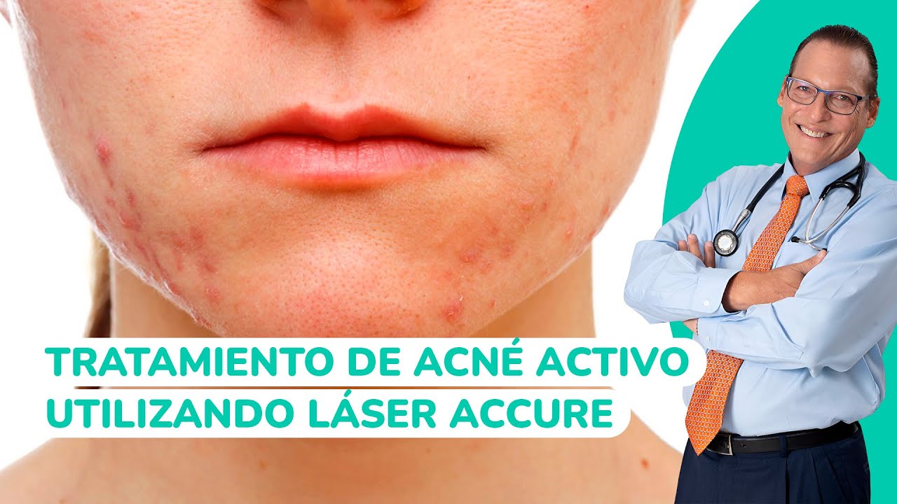 TRATAMIENDO DE ACNE ACTIVO UTILIZANDO LÁSER ACCURE