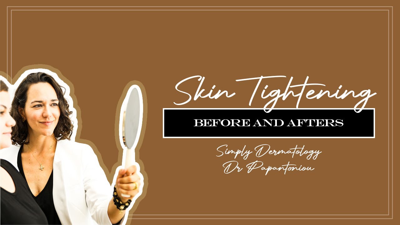 Skin Tightening and Collagen Renewal Treatments | Simply Dermatology | Dr Kally Papantoniou