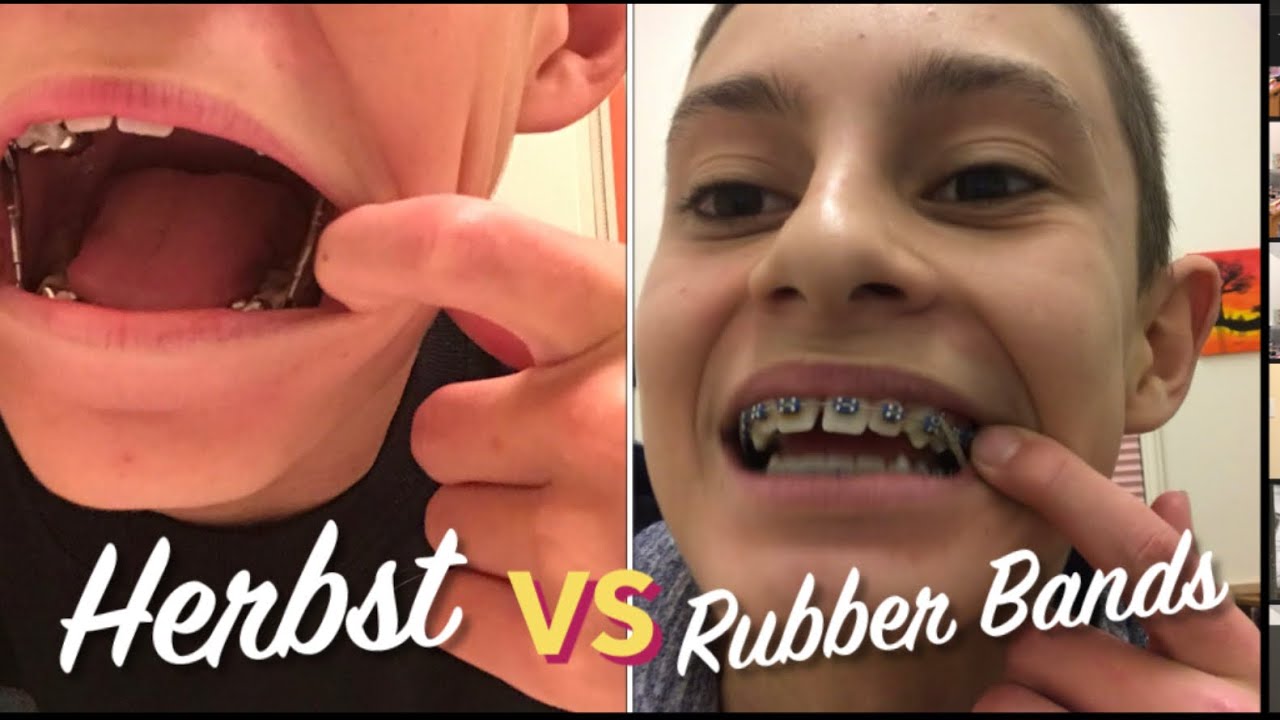 Which Is Better: Herbst Appliance VS Rubber Bands