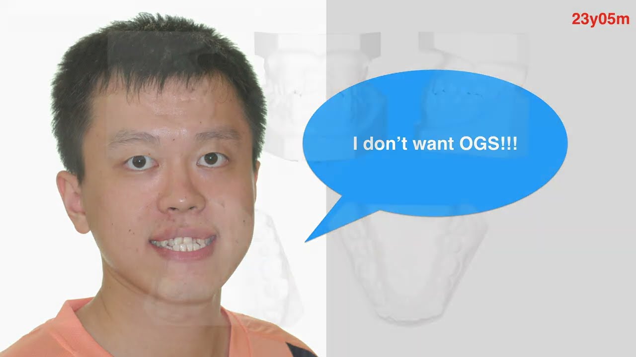 Class III Malocclusion with Anterior Crossbite｜【Chris Chang Ortho】CC419