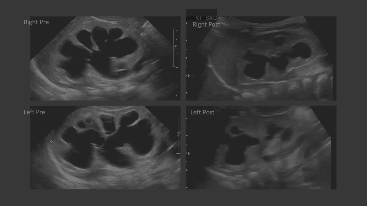 Proactive management of posterior urethral valves  (PUV)