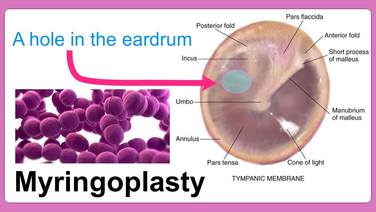 myringoplasty