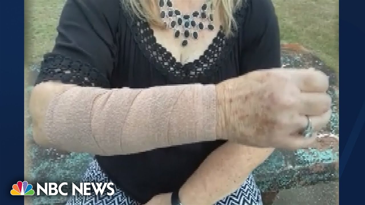 Fangs, feathers and talons: Snake & hawk attack Texas woman