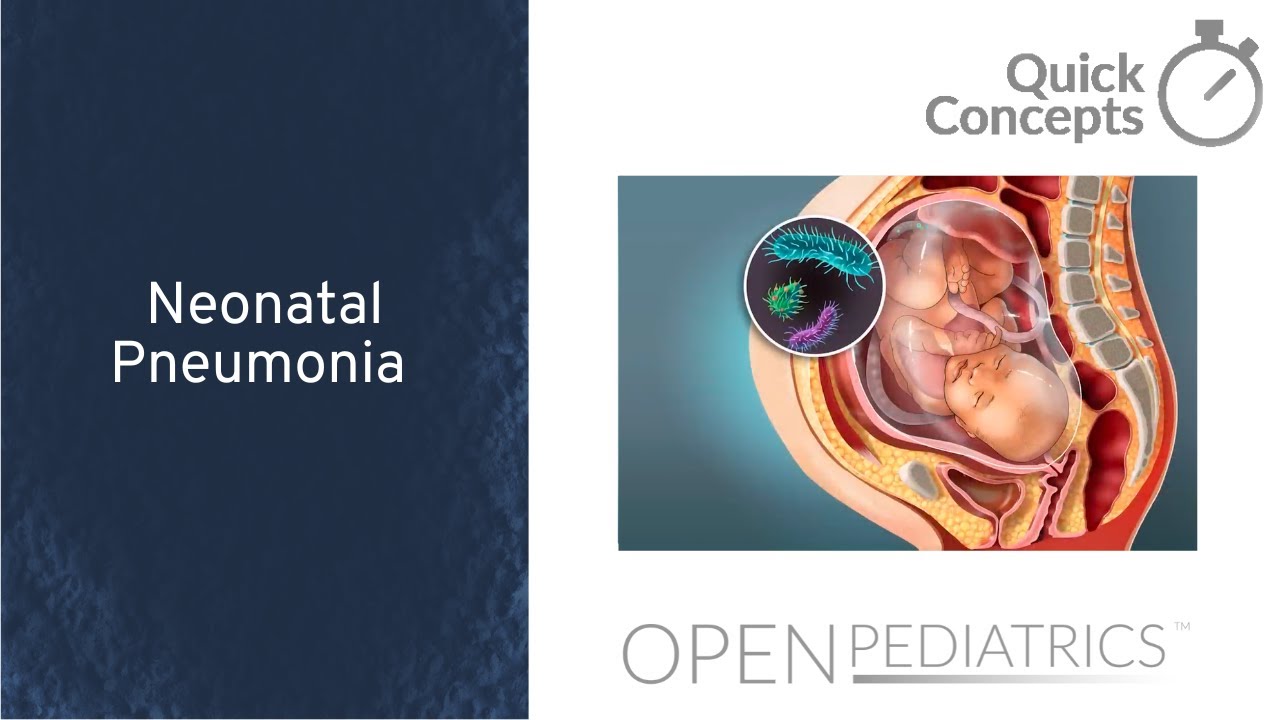 Neonatal Pneumonia ‌by M. Connelly, A. Erickson, L. Rubin‌ | OPENPediatrics