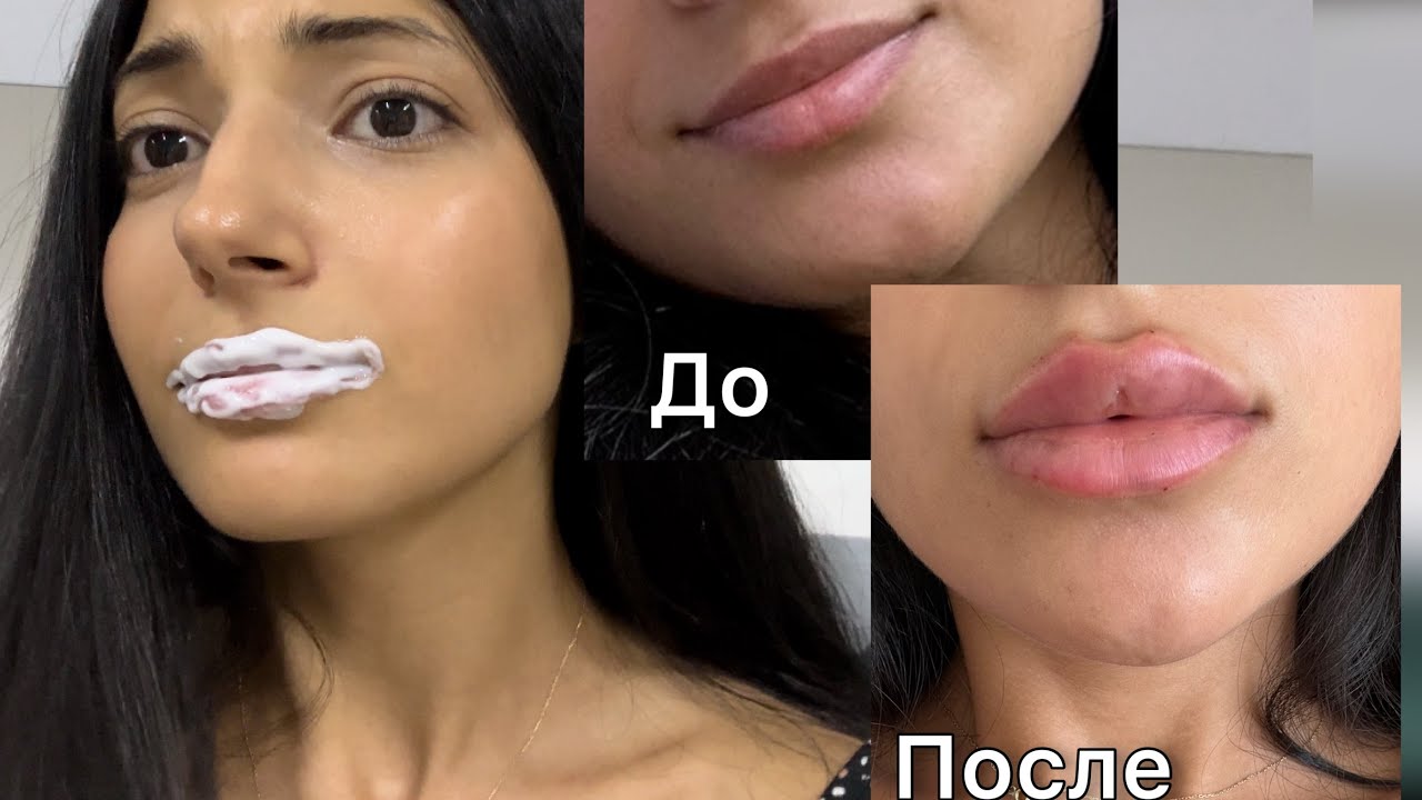 Сделала губы первый раз / Больно или нет ? Препарат Stylage M #сделалагубы