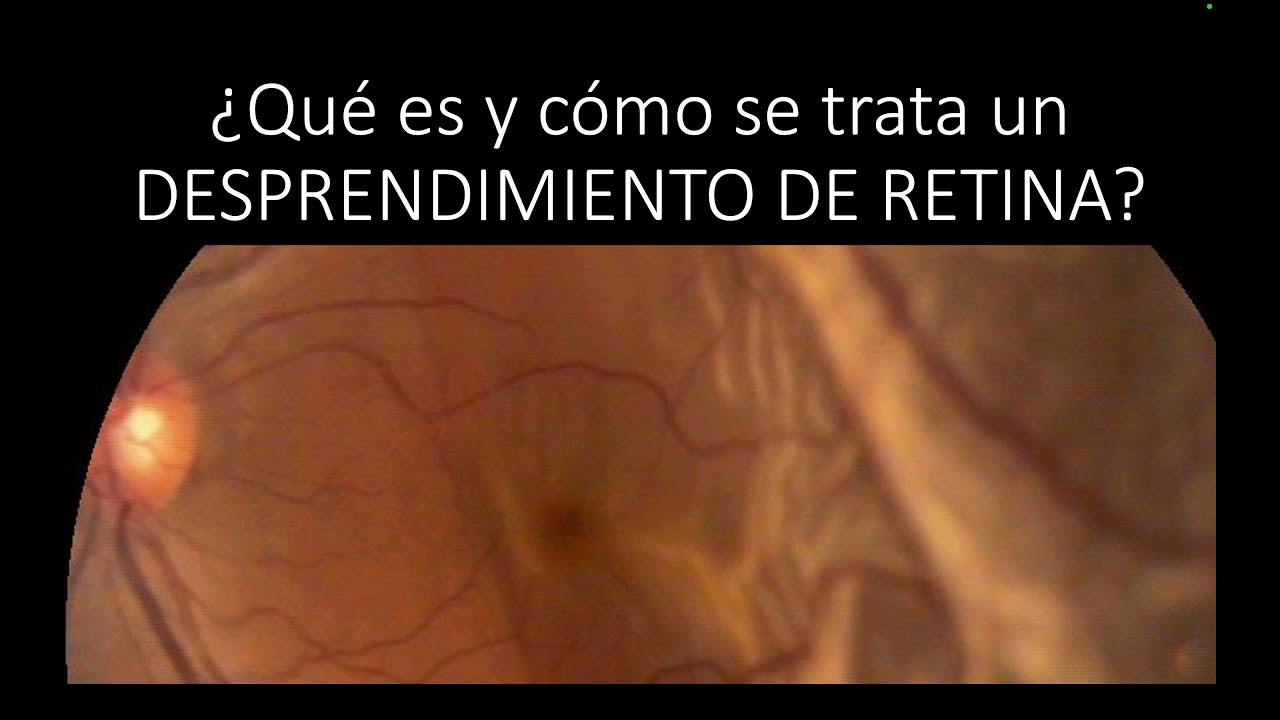 ¿Qué es y cómo se trata un desprendimiento de retina?