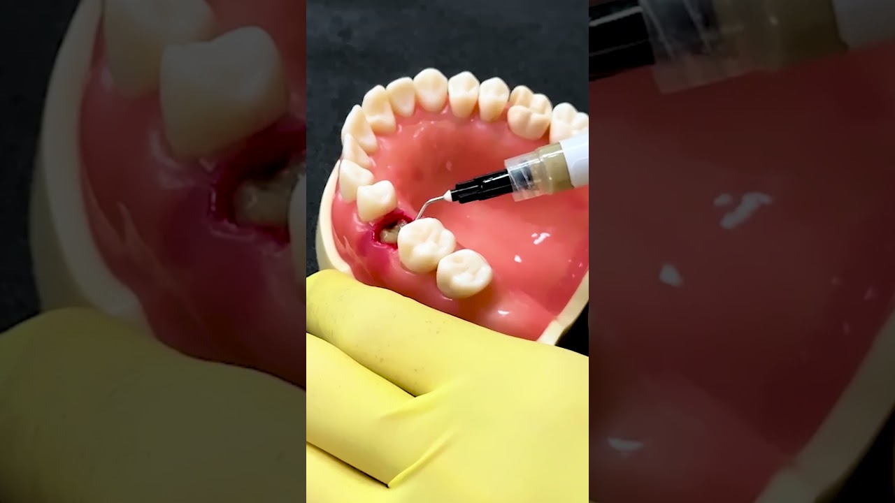Alveolex - Curativo Alveolar (Biodin&acirc;mica) #odontologia #curativo #propolis #exodontia #biodinamica
