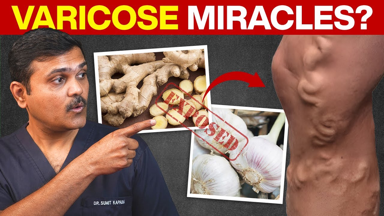STOP Wasting Money on Varicose Vein Remedies That Don't Work!