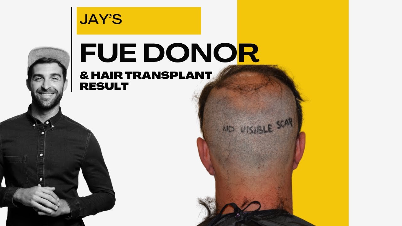 Jay's Hair Transplant Result in India | Best Results at Best Cost of Hair Transplant