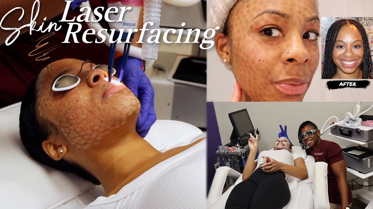 LASER SKIN RESURFACING | What To Expect, Peeling Process, And Final Results ~ Aerolase Era Elite
