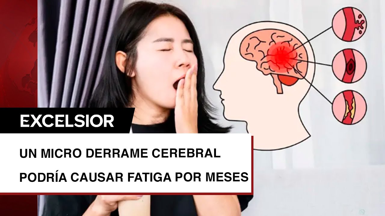 Un micro derrame cerebral podr&iacute;a causar fatiga por meses sin que lo notes