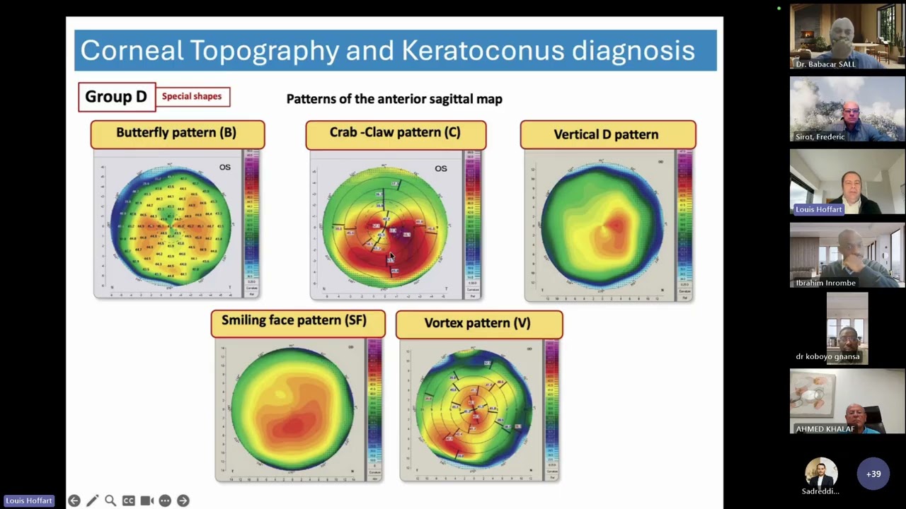 REPLAY WEBINAR - Kératocône du diagnostic précoce au traitement par Cross Linking