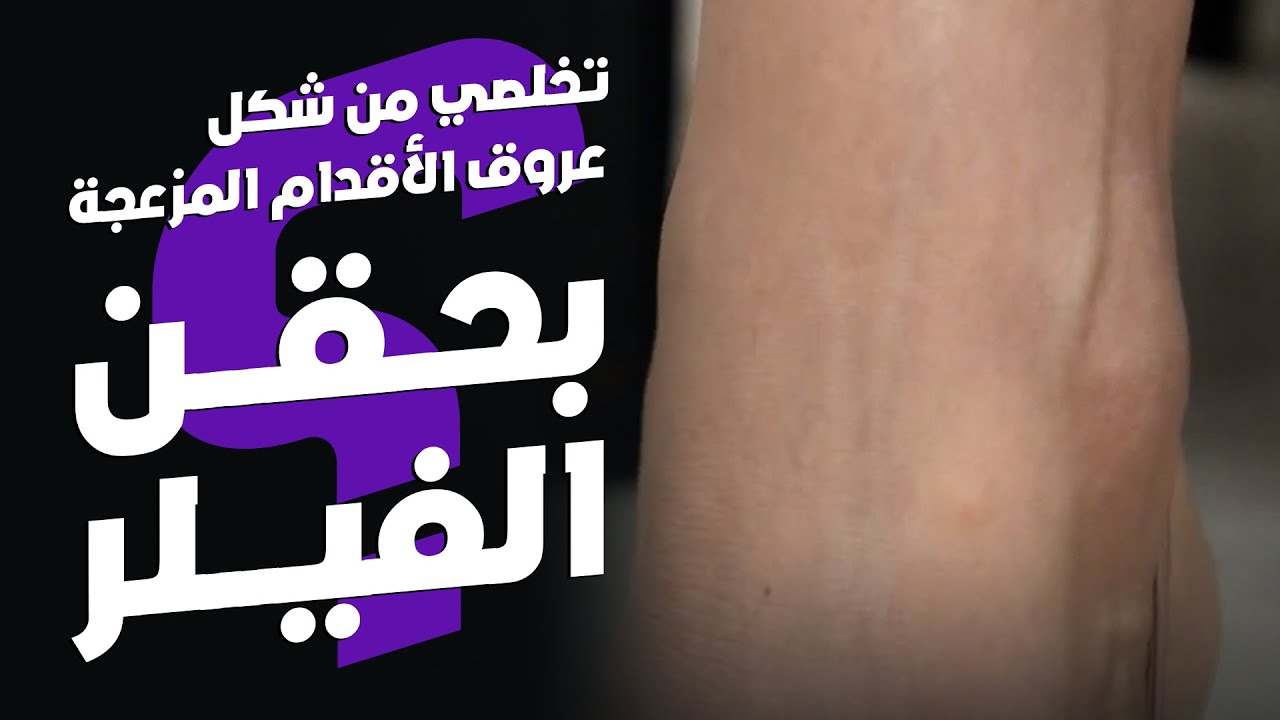 حقن الفيلر للقدمين وإخفاء العروق والأربطة لمظهر أكثر شبابا وامتلاءً (مناسب للرياضيين)