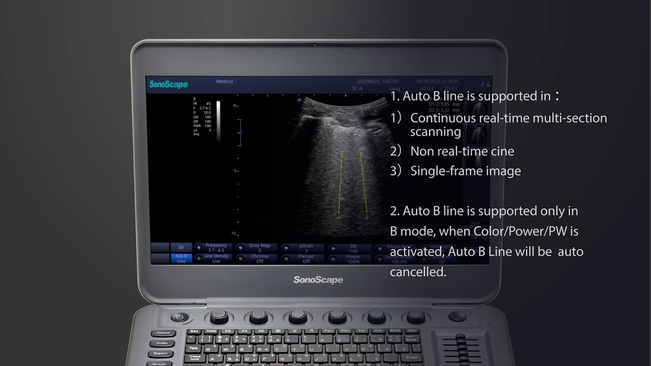 Lung Scan in SonoScape Ultrasound