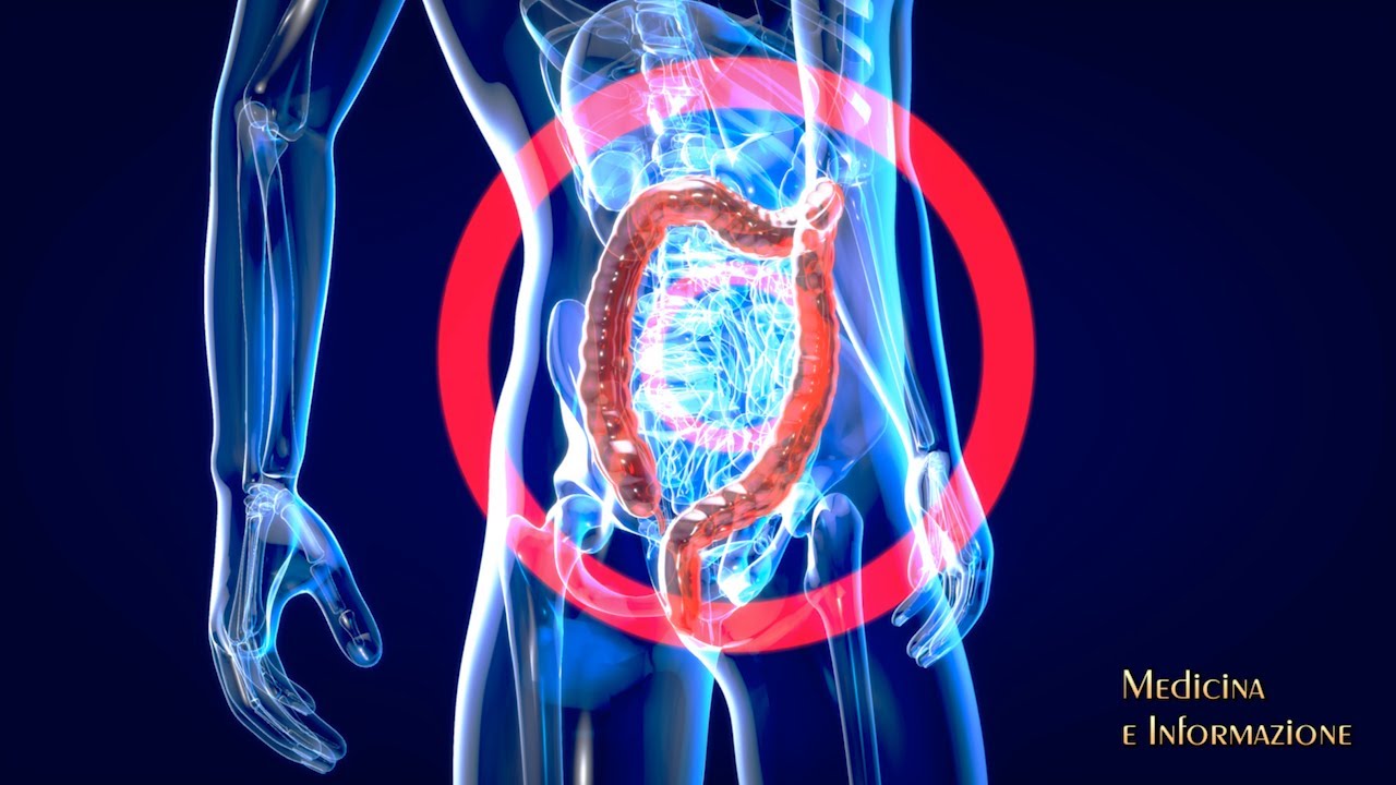 Malattia di Crohn, cellule staminali per trattare le complicanze resistenti ai trattamenti standard