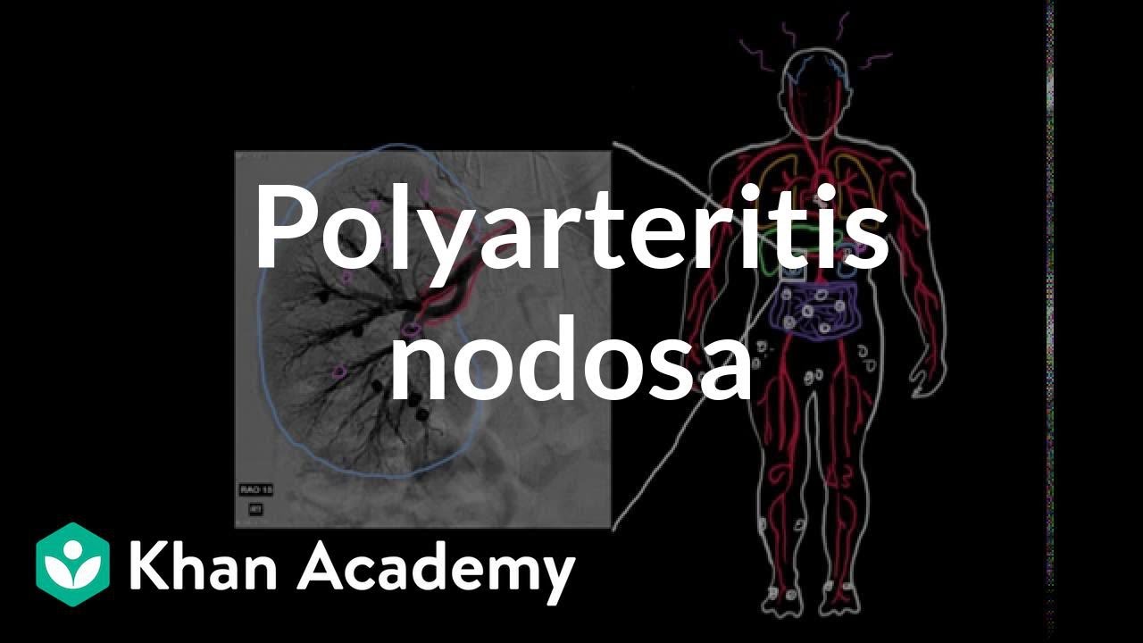 Polyarteritis nodosa | Circulatory System and Disease | NCLEX-RN | Khan Academy