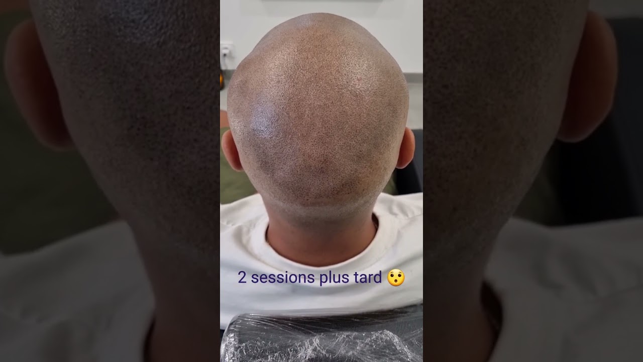 micropigmentation session 2 #dermopigmentation #tricopigmentation #cheveux #micropigmentation