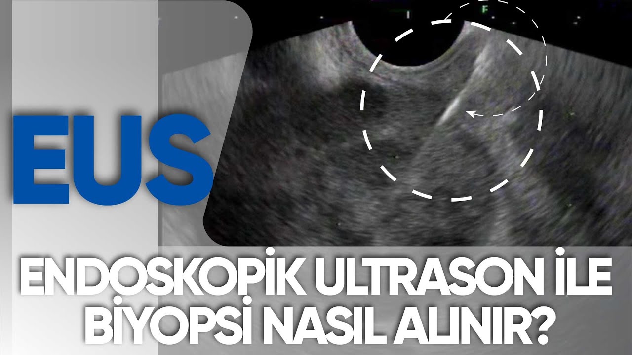 Endoskopik Ultrason (EUS) ile biyopsi alımı | Prof.Dr. Yusuf AKCAN