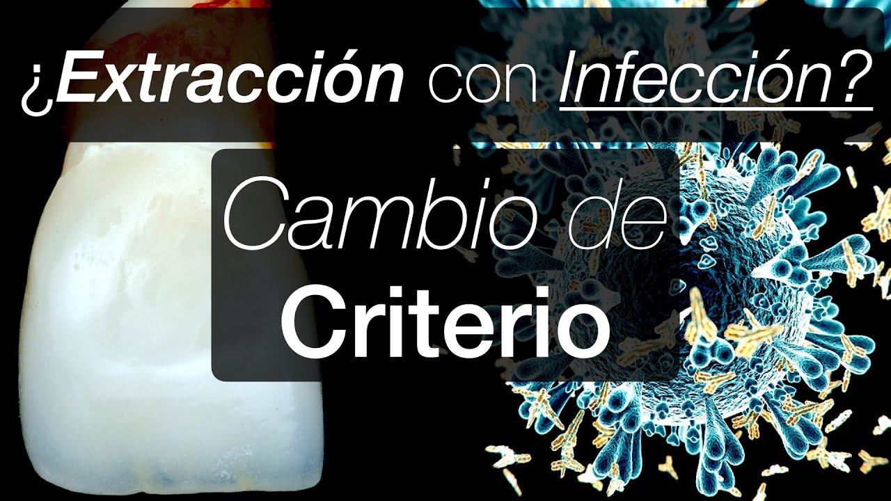 Extracción muela infectada: ¿Podemos realizar la extracción? El Criterio ha CAMBIADO