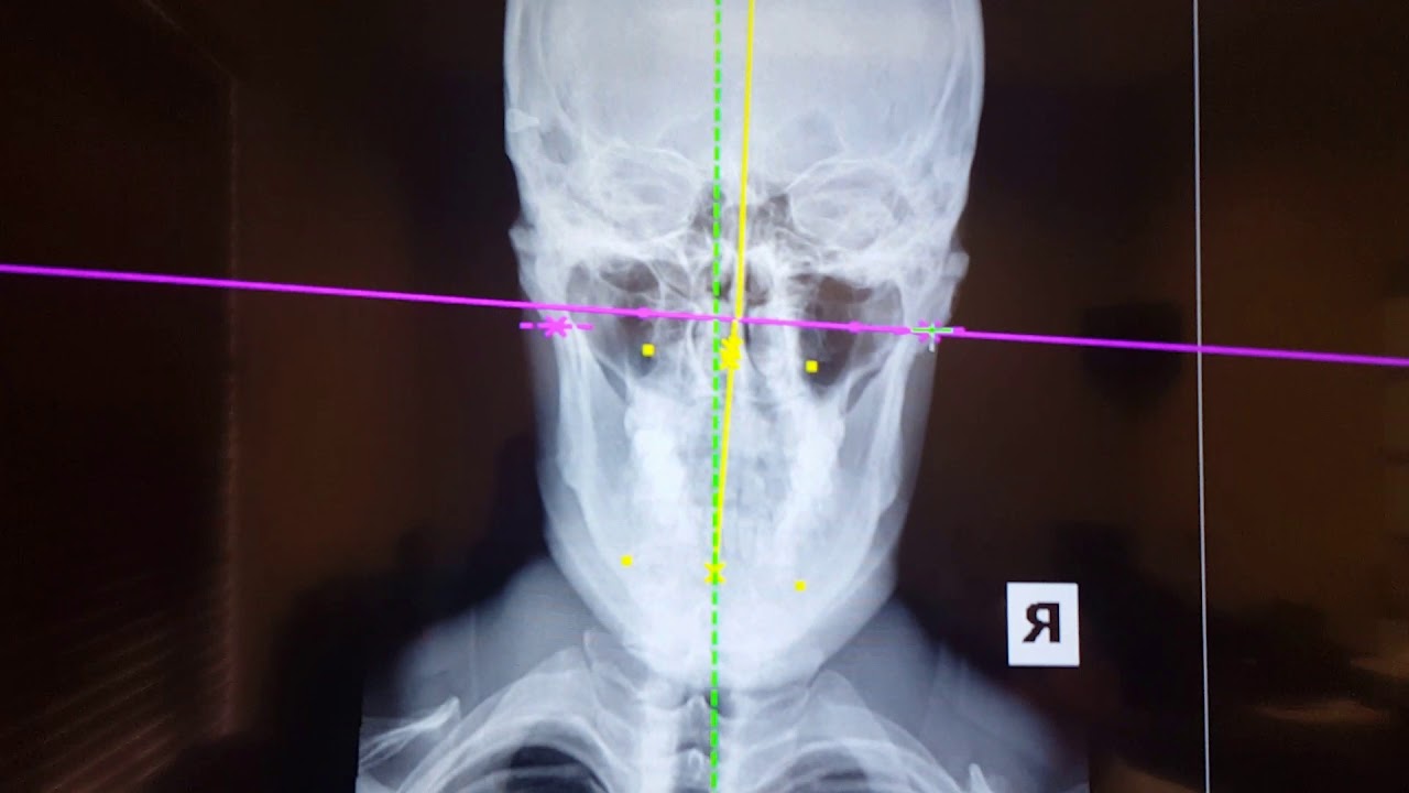 Atlas Orthogonal x-ray analysis