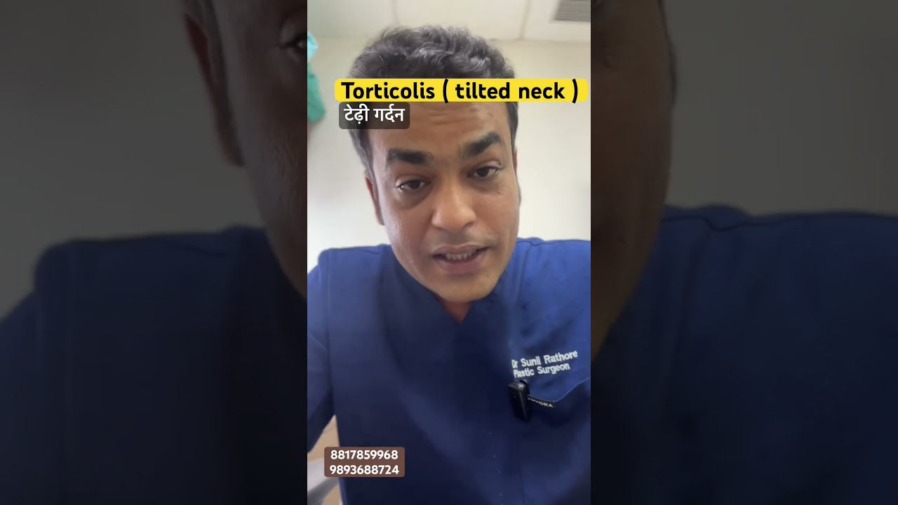 Torticolis treatment : surgery is always best option #drsunilrathore #bhopal #torticolis