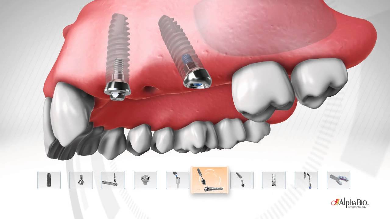 Alpha-Bio's Screw Retained Line | ALPHA-BIO TEC.