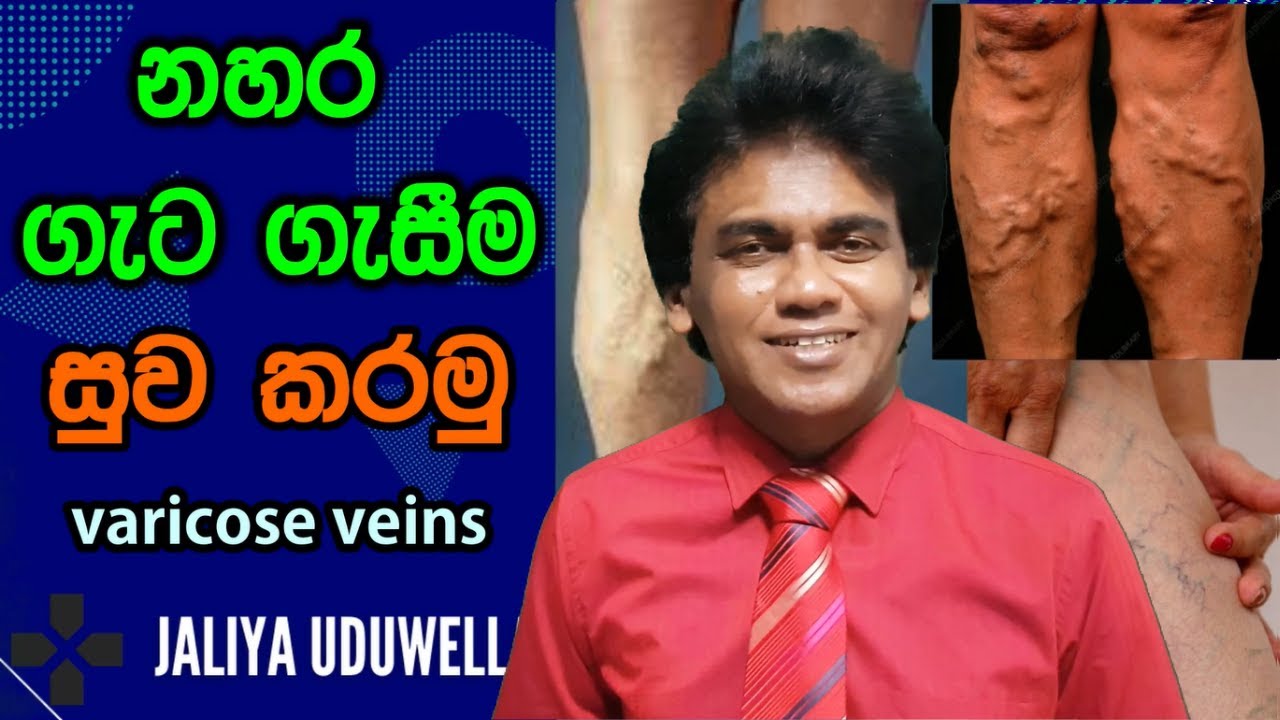 Varicose Veins Sinhala | Treatment for Varicose & Spider Veins | නහර ගැට ගැසීමට ප්රතිකාර / බෙහෙත්