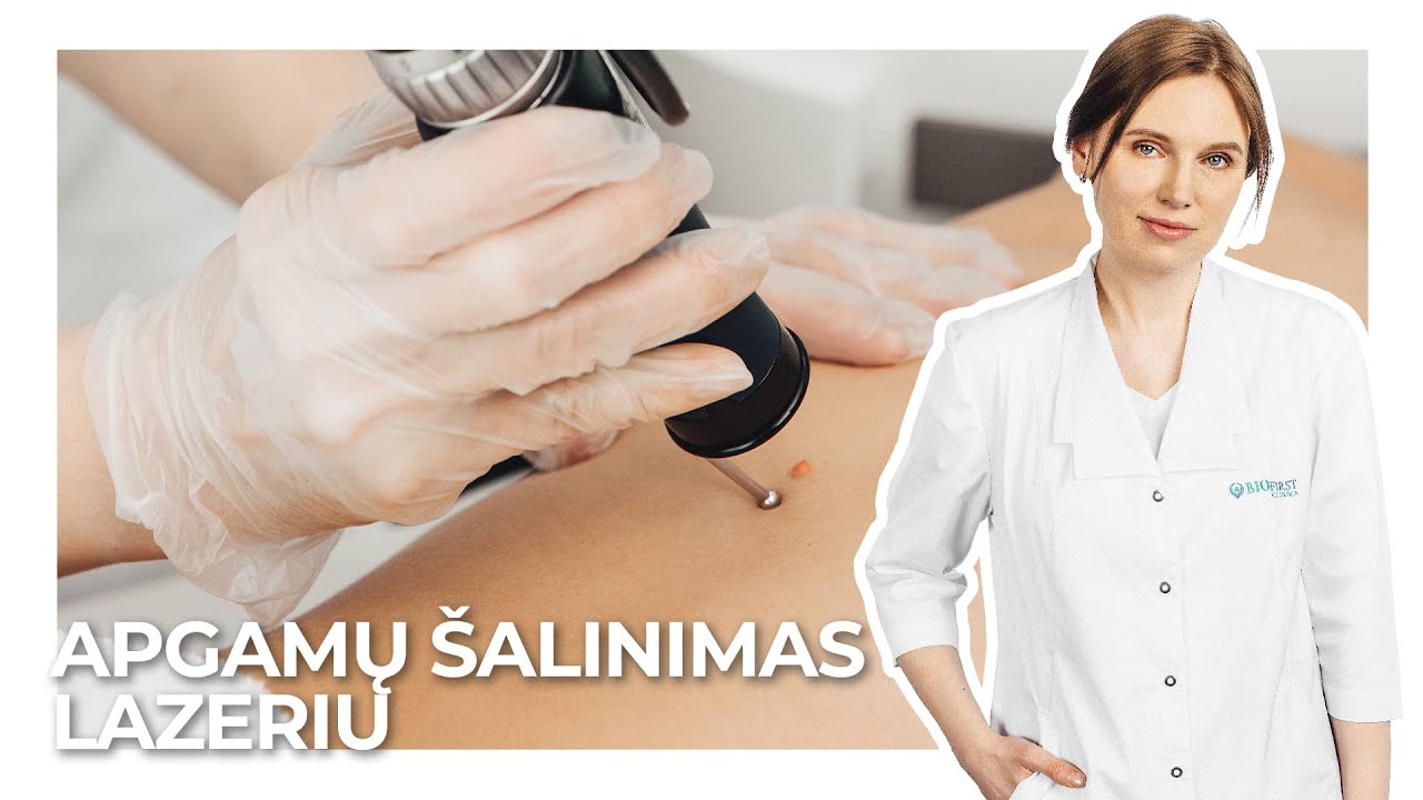 Apgamų šalinimas lazeriu: ką reikia žinoti prieš procedūrą? | Dr. Silvija Kontautienė