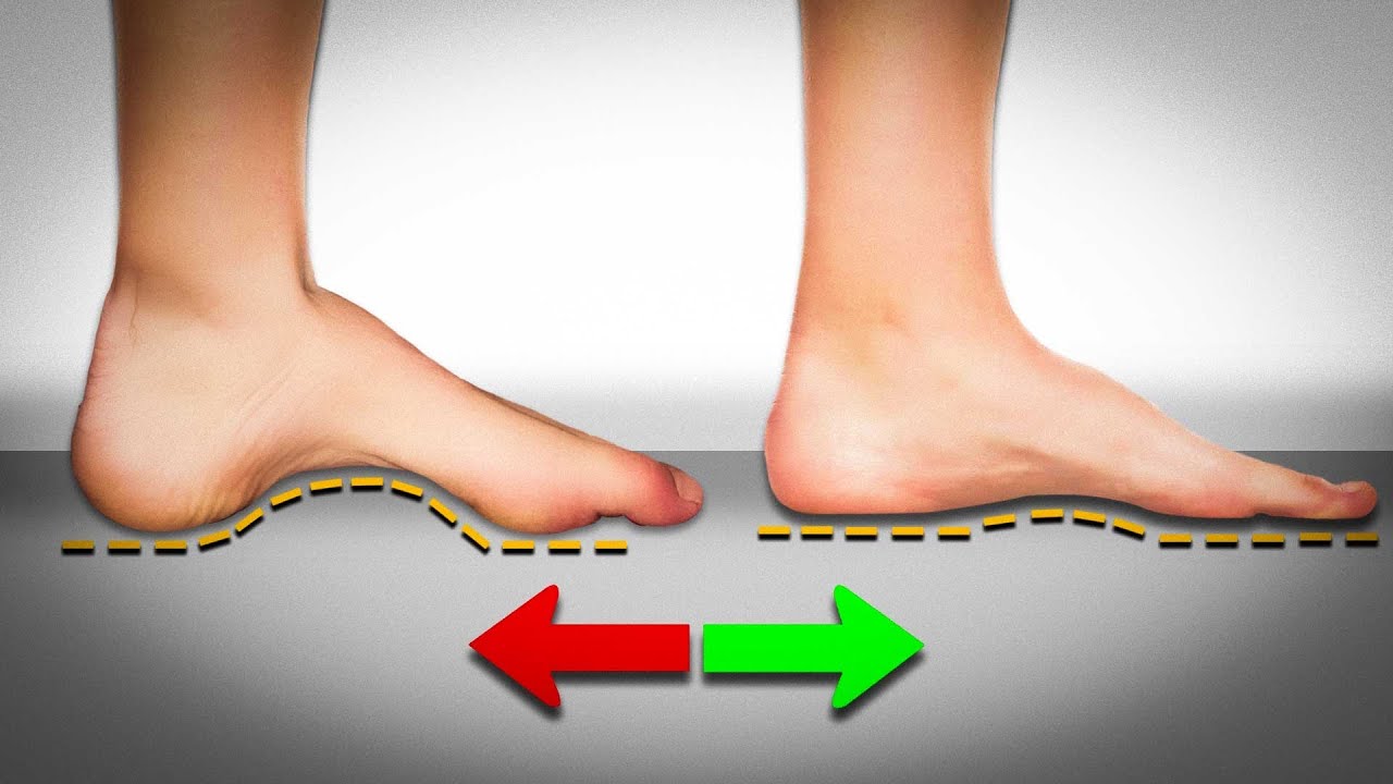 Fix Your High Foot Arch In One Easy Exercise