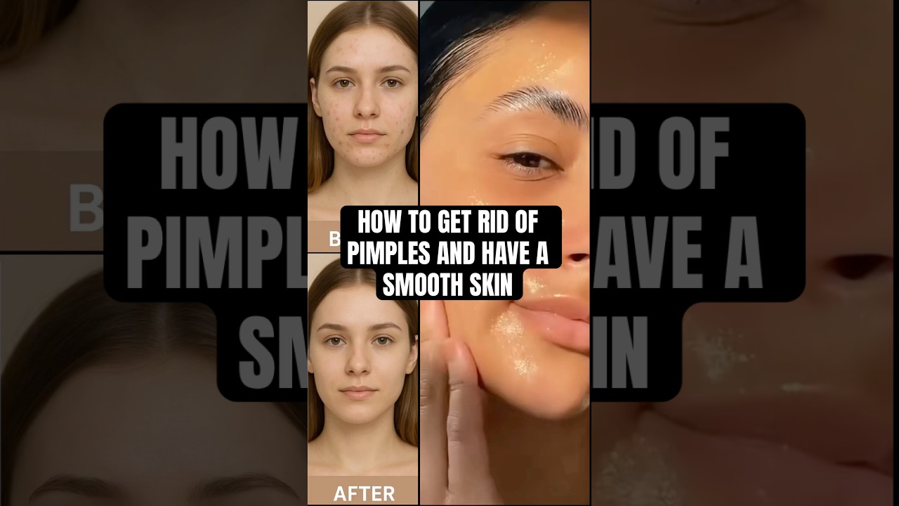 How to get rid of pimples and get a smooth skin. #acnetreatment #pimples #naturalremedy