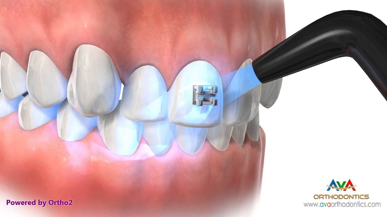 Orthodontic Treatment for Crowding - Different Stages