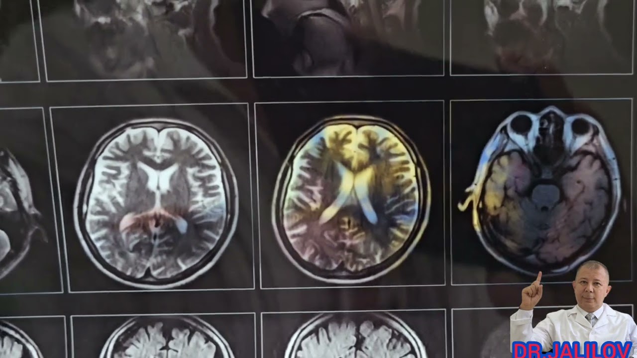 MANIAKAL-DEPRESSIV PSIXOZ - KASALLIK BELGILARI, DIAGNOSTIKA VA DAVOLASH