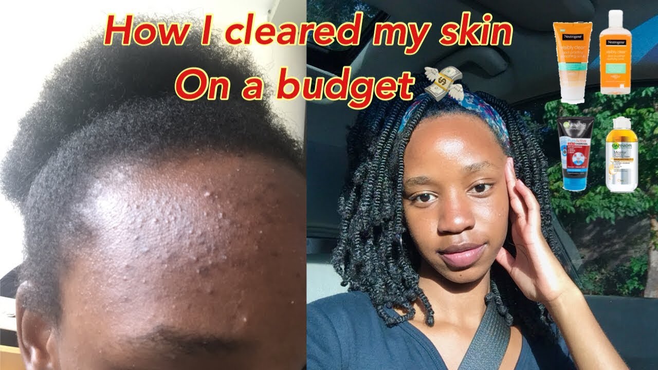 HOW I CLEARED MY SKIN ON A BUDGET💸